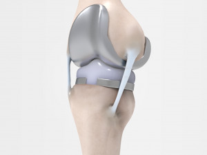 Knee Replacement 3D Model