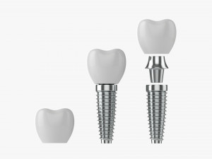 Tooth Implant 3D Model